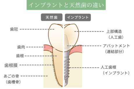 インプラントと天然歯の違い