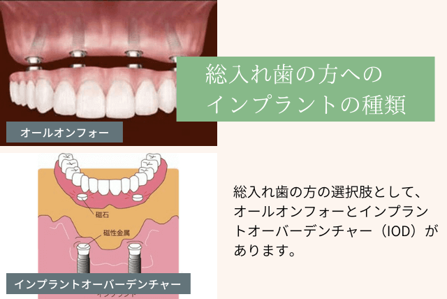 総入れ歯の方へのインプラントの種類