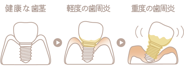 インプラント周囲炎