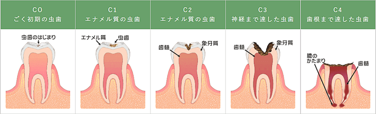 虫歯 治療 麻酔 切れ た 後 痛い