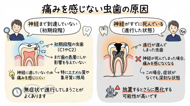 痛みを感じない虫歯の原因の図解