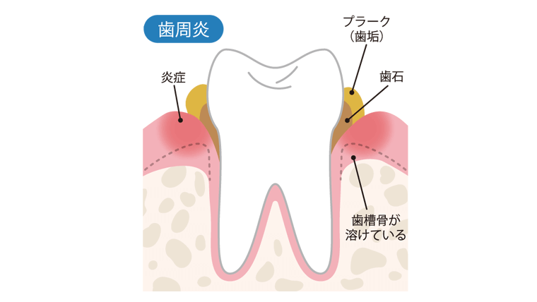 歯肉炎のイラスト