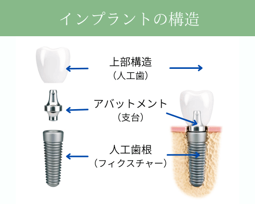 インプラントの構造