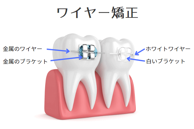 ワイヤー矯正