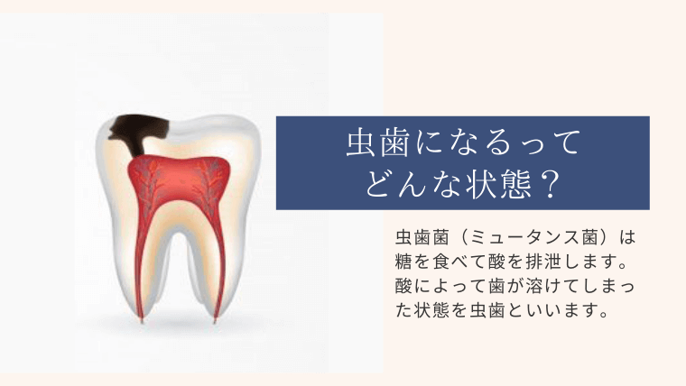 虫歯になるってどんな状態？