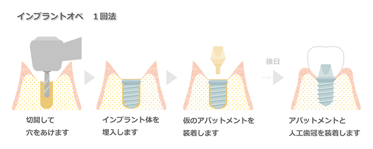 インプラントオペ1回法