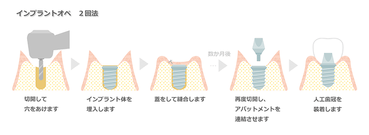 インプラントオペ2回法