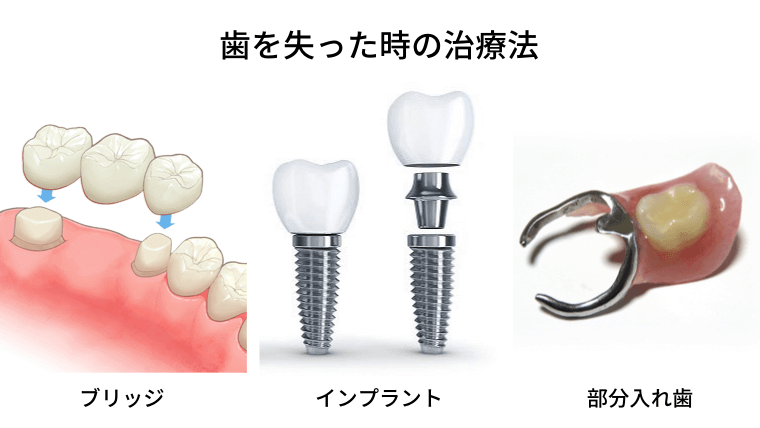 歯を失った時の治療法