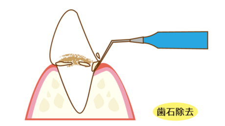 歯石取り