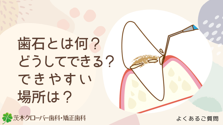 歯石とは何？どうしてできる？できやすい場所は？