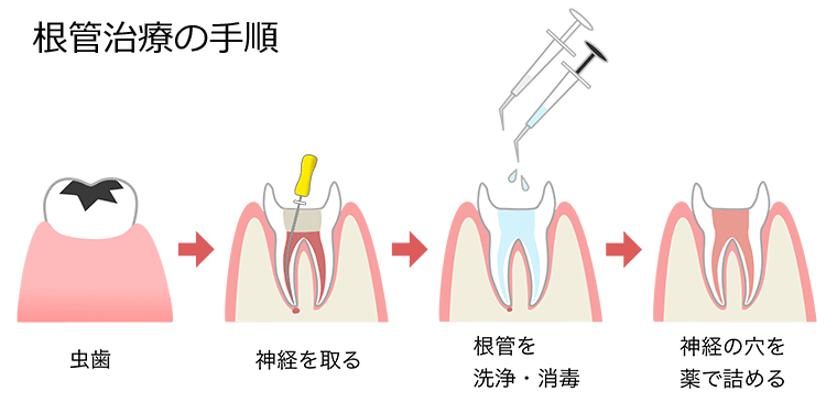 根管治療の手順