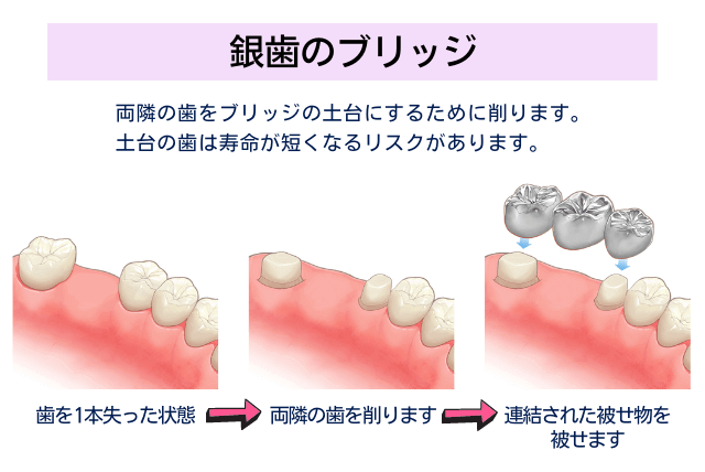 銀歯のブリッジ