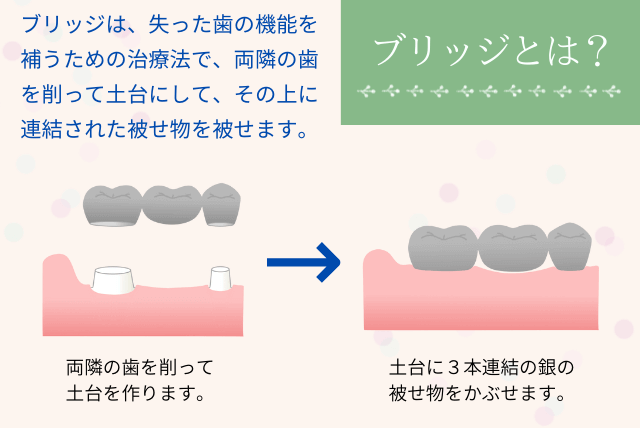 ブリッジとは