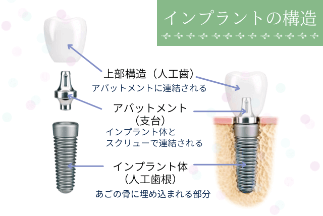 インプラントの構造