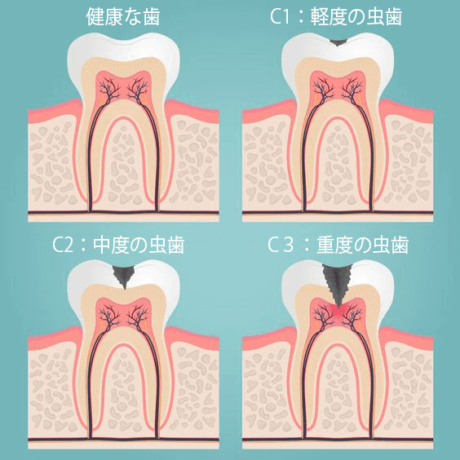 虫歯の進行