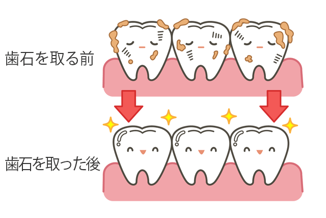 歯石を取る前と後