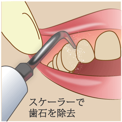 歯石取り