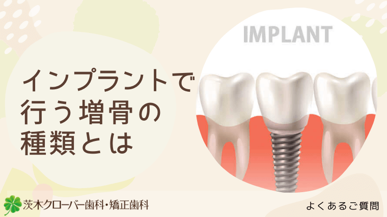 インプラントで行う増骨の種類とは