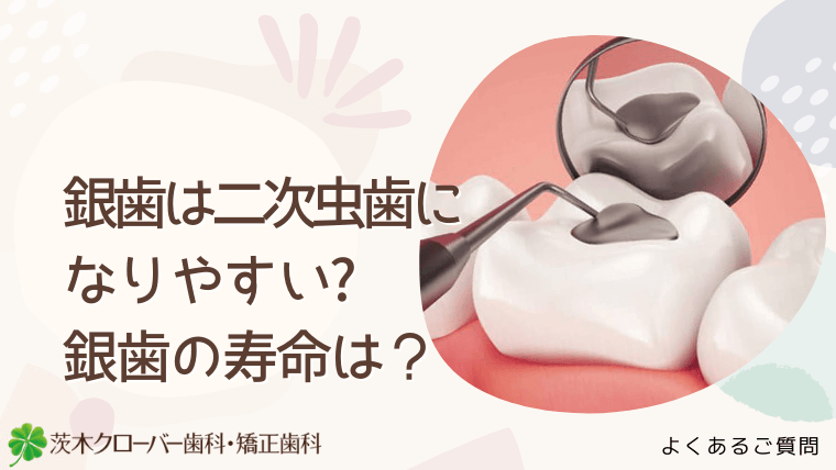 なぜ銀歯は二次虫歯になりやすいの?銀歯の寿命は何年？