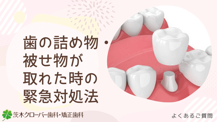 歯の詰め物・被せ物が取れた時の緊急対処法