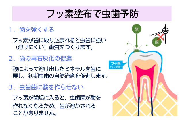 フッ素塗布で虫歯予防