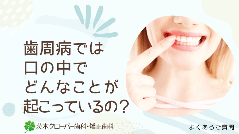 歯周病では口の中でどんなことが起こっているの？