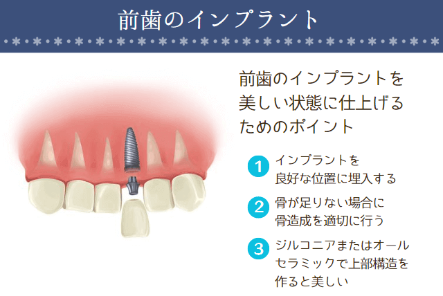 前歯のインプラント