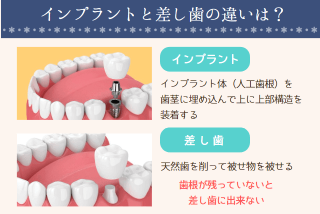 インプラントと差し歯の違いは？