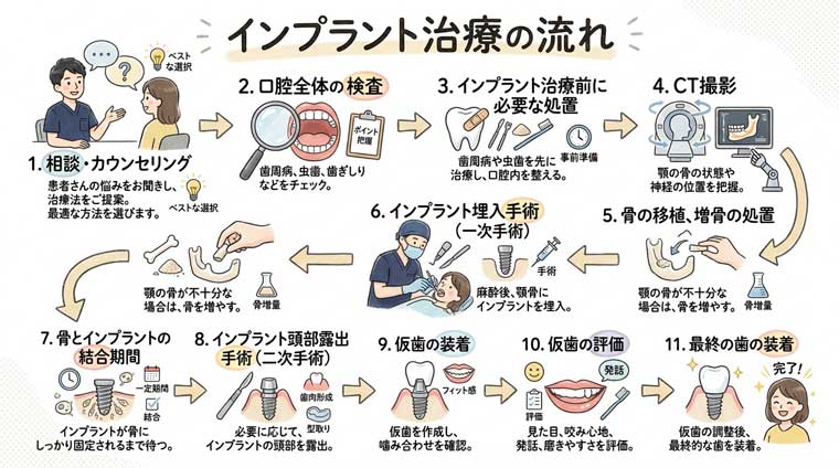 インプラント治療全体の流れと相談、カウンセリングの重要性｜茨木