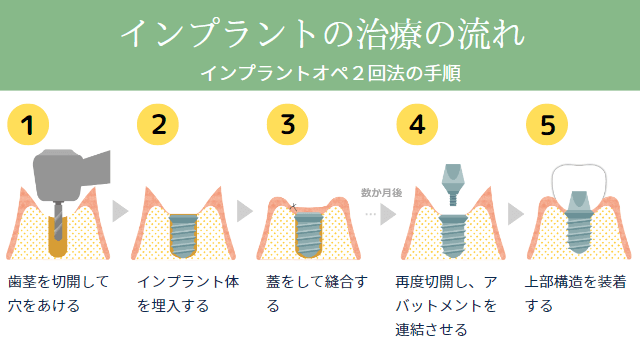 インプラントの治療の流れ