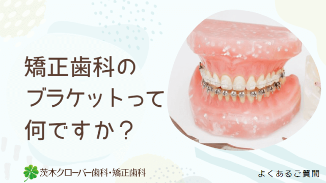 矯正歯科のブラケットって何ですか？