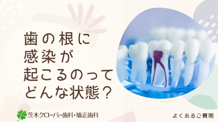 歯の根に感染が起こるのってどんな状態？