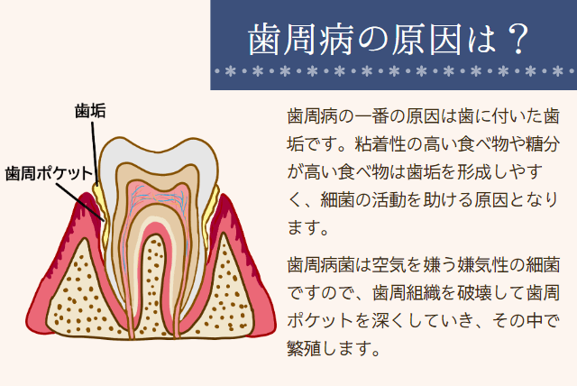 歯周病の原因は？