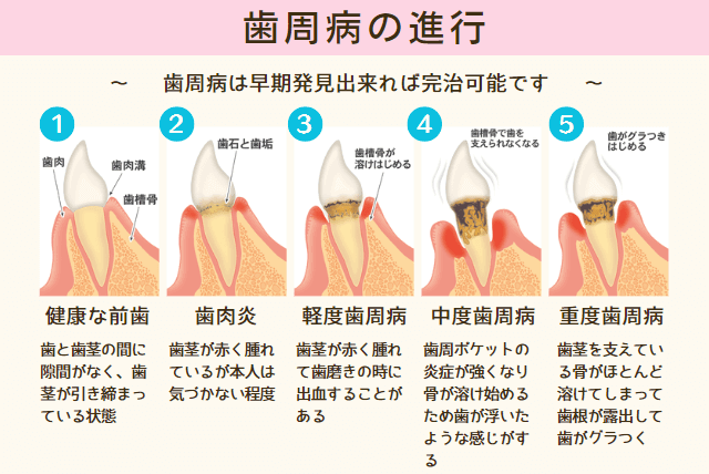 歯周病の進行