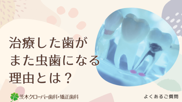 治療した歯がまた虫歯になる理由とは？