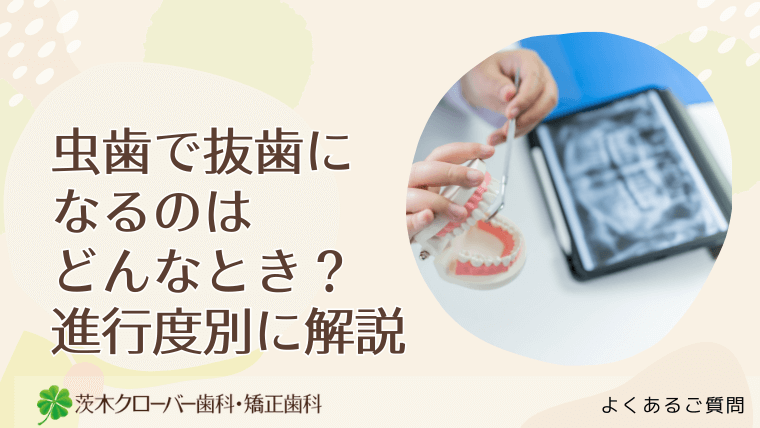 虫歯で抜歯になるのはどんなとき?進行度別に解説
