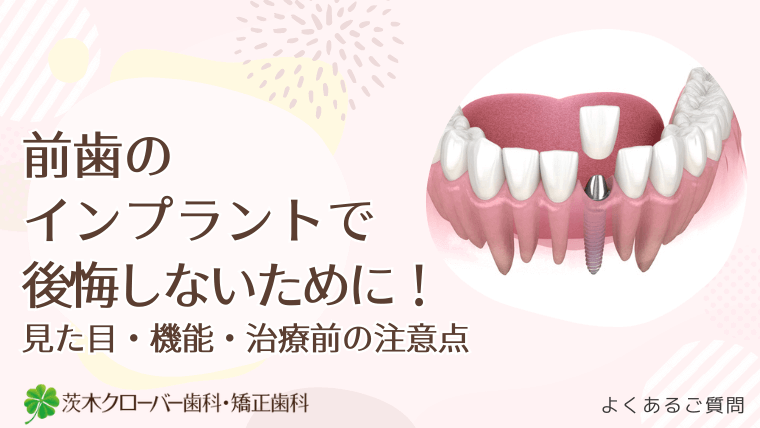 前歯のインプラントで後悔しないために!
