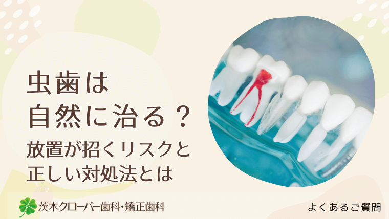 虫歯は自然に治る?放置が招くリスクと正しい対処法とは