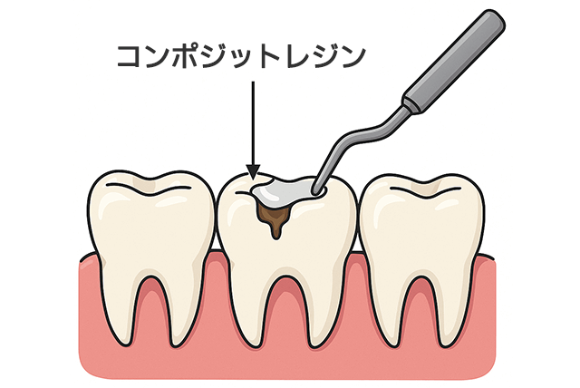 コンポジットレジン
