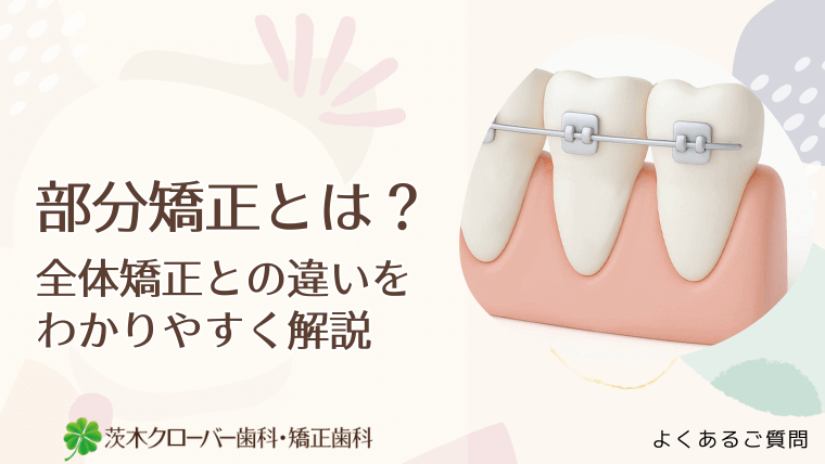 部分矯正とは？全体矯正との違いをわかりやすく解説