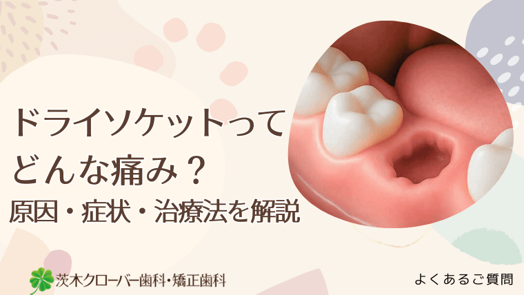 ドライソケットってどんな痛み？原因・症状・治療法を解説