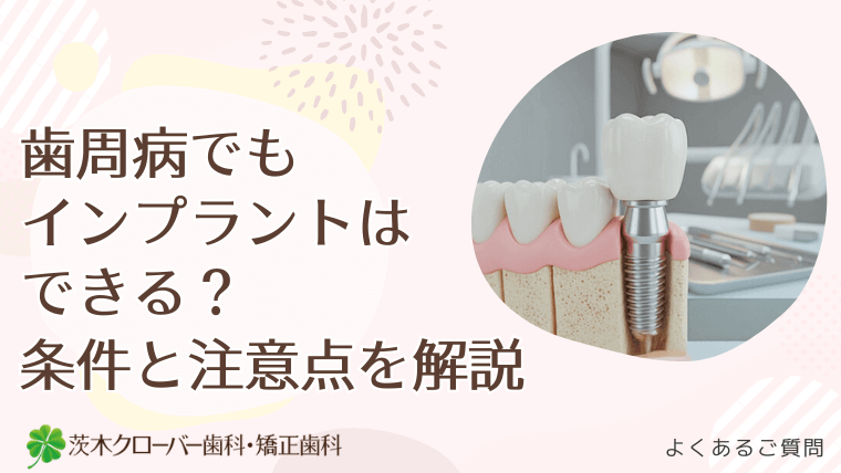 歯周病でもインプラント治療はできる？