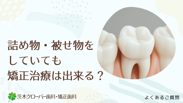 詰め物・被せ物をしていても矯正治療は出来る？