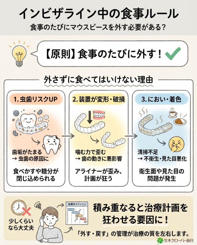 インビザライン中は、食事のたびにマウスピースを外す必要がありますか？