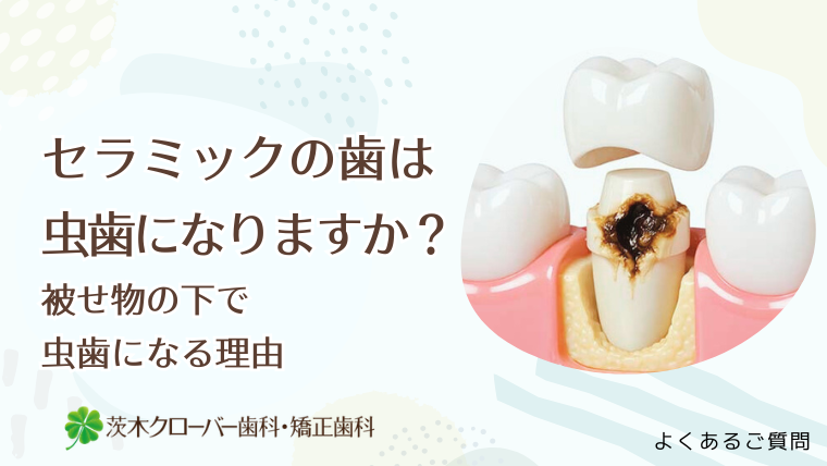 セラミックの歯は虫歯になりますか？被せ物の下で虫歯になる理由