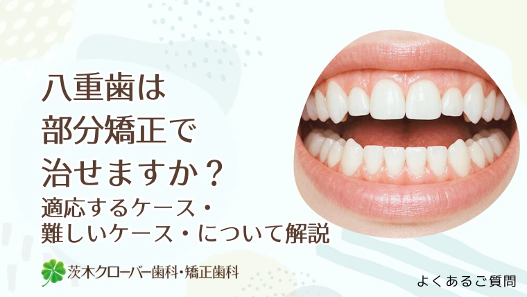 八重歯は部分矯正で治せますか？適応するケース・難しいケース・について解説