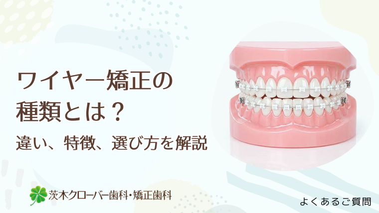 ワイヤー矯正の種類とは？違い、特徴、選び方を解説