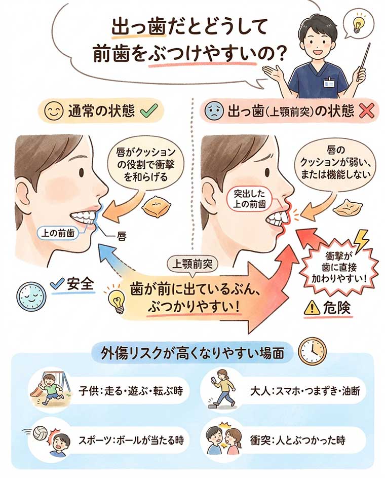 出っ歯だとどうして前歯をぶつけやすいの？の図解