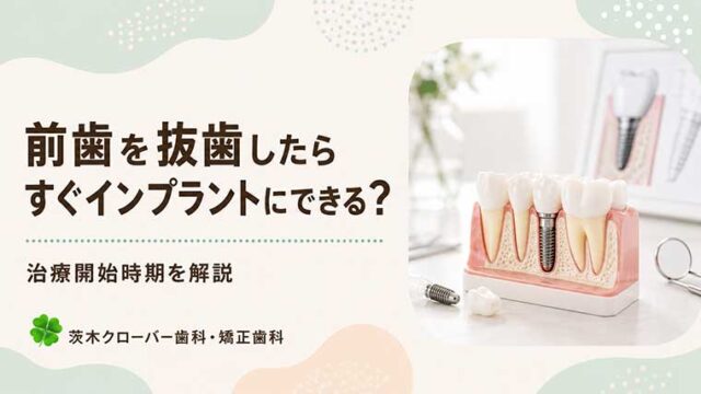 前歯を抜歯したらすぐインプラントにできる？治療開始時期を解説