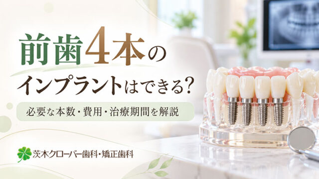前歯4本のインプラントはできる？必要な本数・費用・治療期間を解説